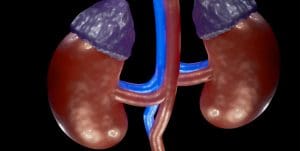 Fokal segmentale Glomerulosklerose